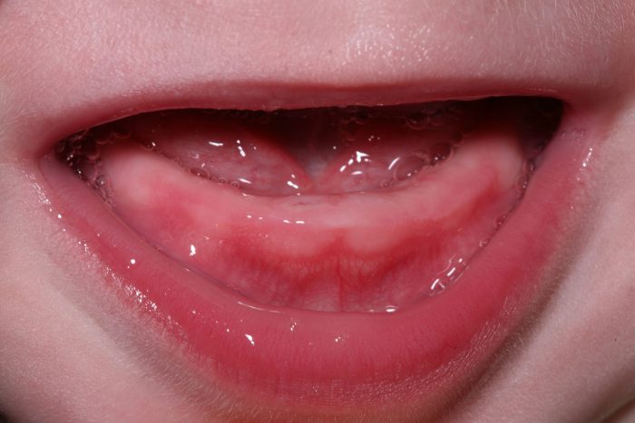 baby teething swollen gums